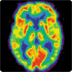 Positron emission tomography image of a human brain