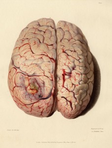 Medical-Anatomical-Superior-half-of-diseased-brain