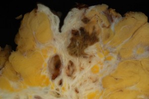 Endometrial tissue embedded in abdominal wall
